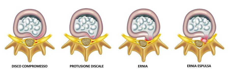 DISCOPATIA ED ERNIA DEL DISCO… RISOLUZIONE E PREVENZIONE CON L’OSTEOPATIA!!